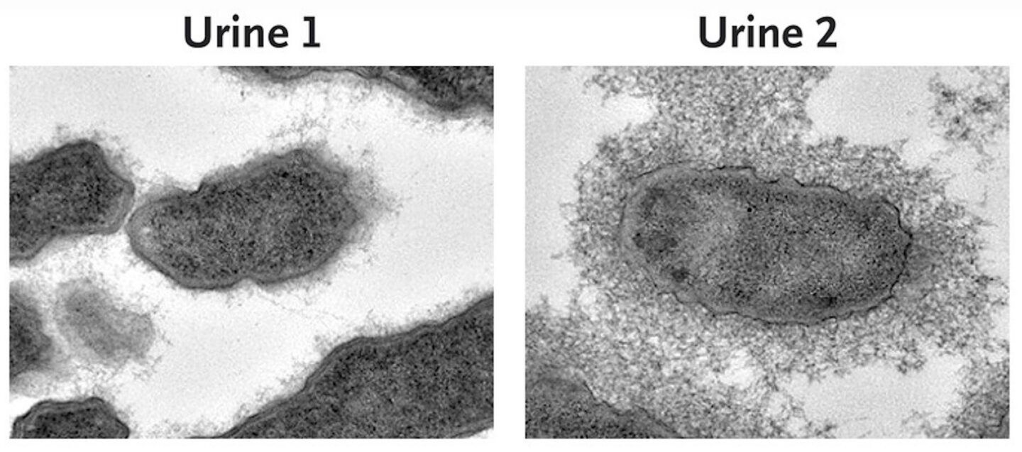 Imágenes de microscopía electrónica de aislamientos de Klebsiella pneumoniae procedentes de muestras de orina.